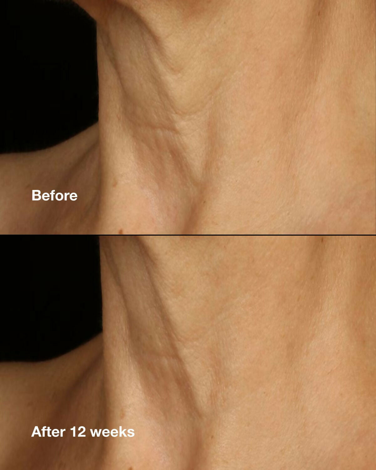 Clinique Smart Clinical Repair Lifting Face & Neck Cream - Distacart